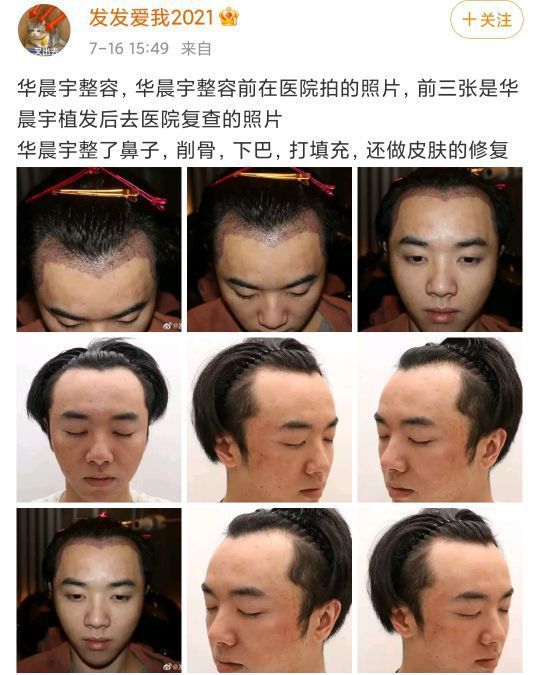 男子植发失败之谜，无效与反光问题探究及解决方案