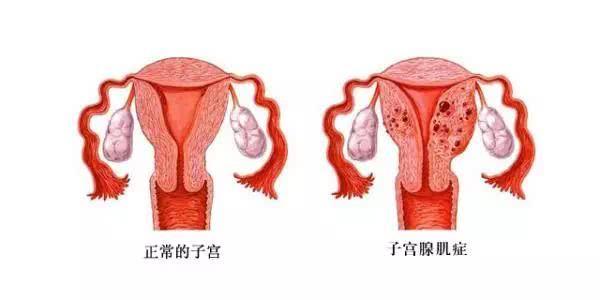 十九岁女生面临痛经与子宫切除的选择困境